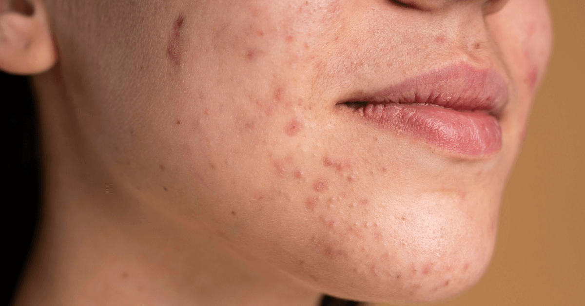 Natural Progesterone Cream for Acne Management